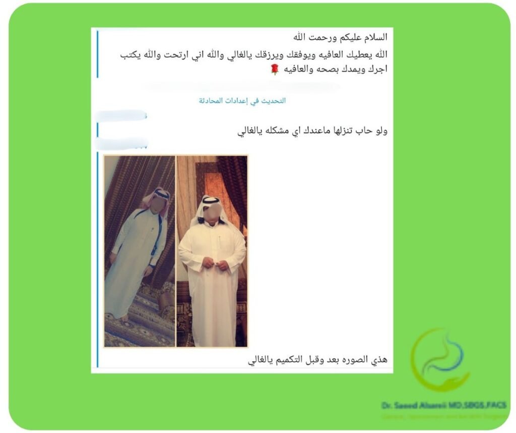 تكميم المعدة