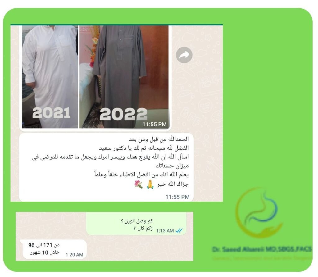 تكميم المعدة