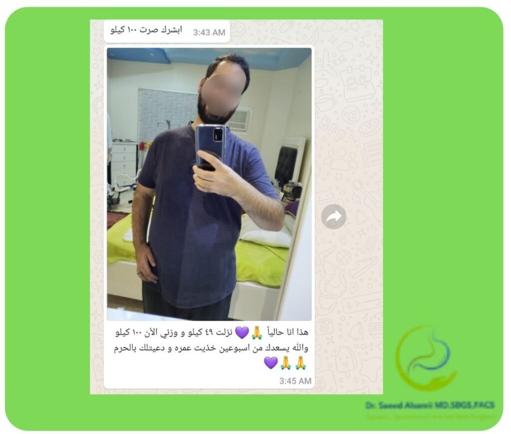 تكميم المعدة