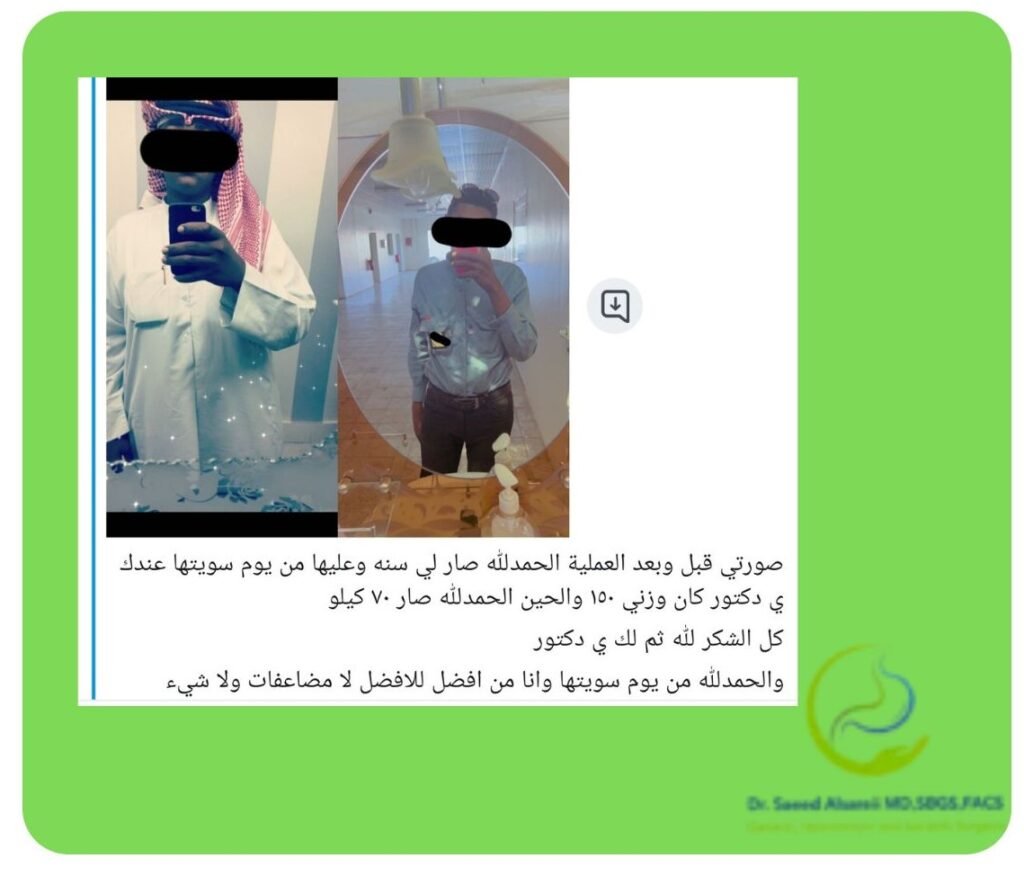 تكميم المعدة