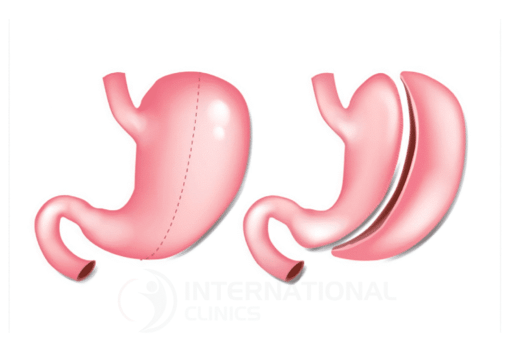 بالونة المعدة لحل فعال للتحكم في الوزن وتحسين الصحة
