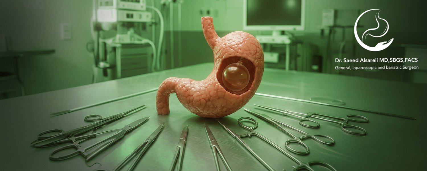 بالونة المعدة لحل فعال للتحكم في الوزن وتحسين الصحة
